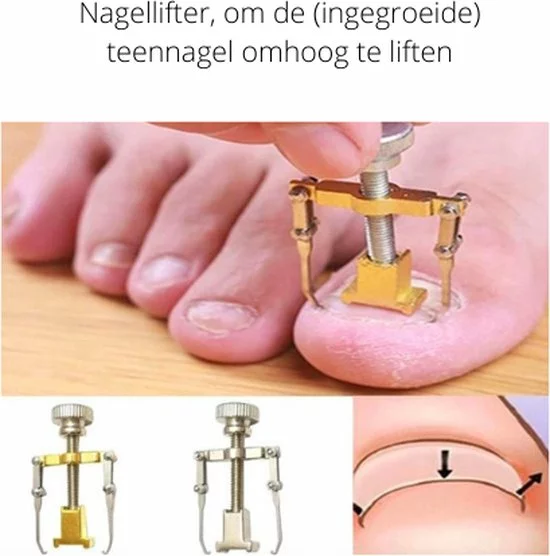 Top 10 ???? Wanties Ingegroeide Teennagel Complete 5-in 1 Set | Gereedschap Om Ingegroeide Nagels Te Verhelpen + Nageltang Nagelknipper | Nagellifter / Corrector Pleister | Kalknagel Kalknagels Nagellifter Lifter Pedicure | Nagelbeugel Nagelbeugeltjes ???? 6 Top 10 ???? Wanties Ingegroeide Teennagel Complete 5-in 1 Set | Gereedschap Om Ingegroeide Nagels Te Verhelpen + Nageltang Nagelknipper | Nagellifter / Corrector Pleister | Kalknagel Kalknagels Nagellifter Lifter Pedicure | Nagelbeugel Nagelbeugeltjes ???? - Afbeelding 6